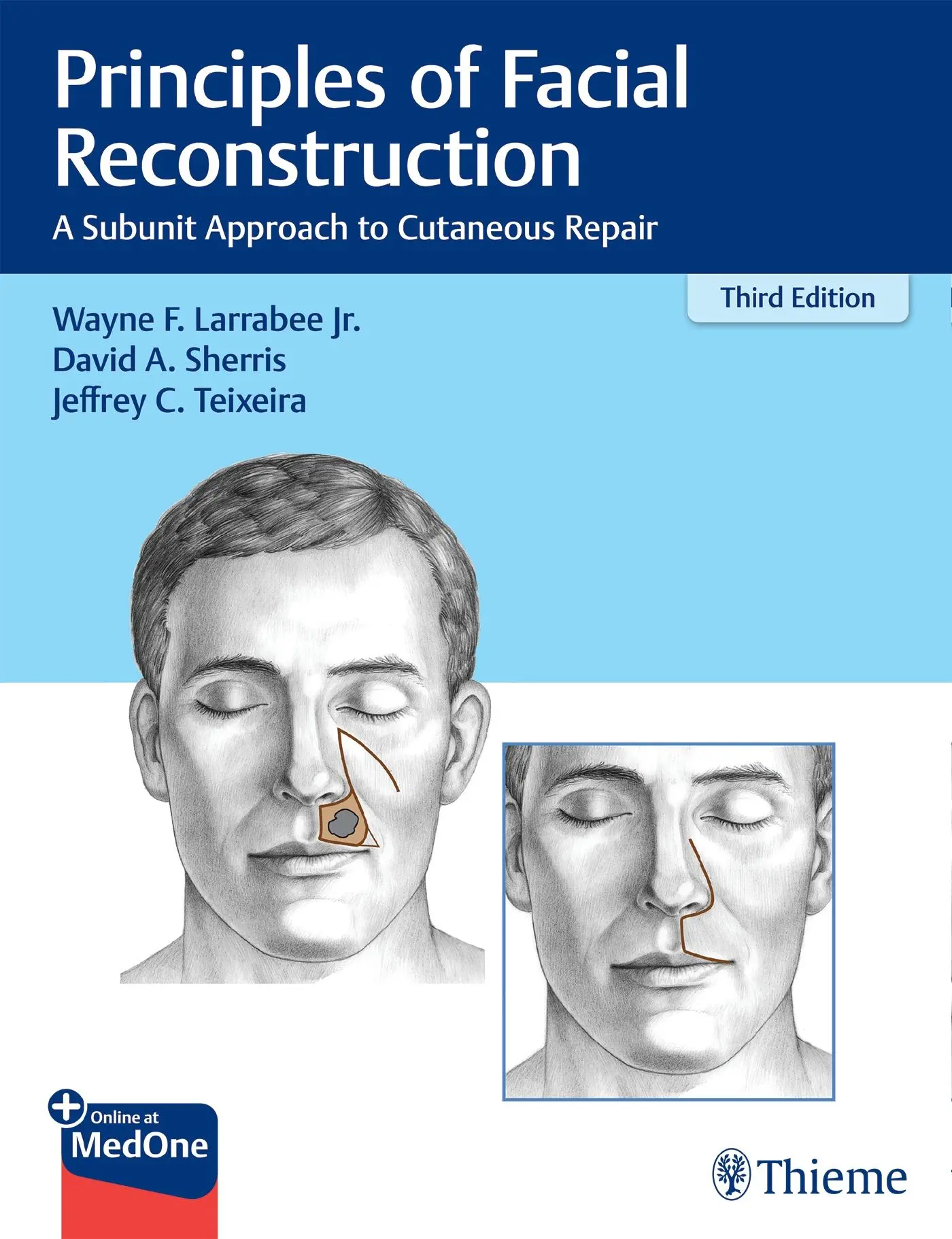 Principles of Facial Reconstruction | A Subunit Approach to Cutaneous ...